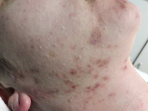 acne-before